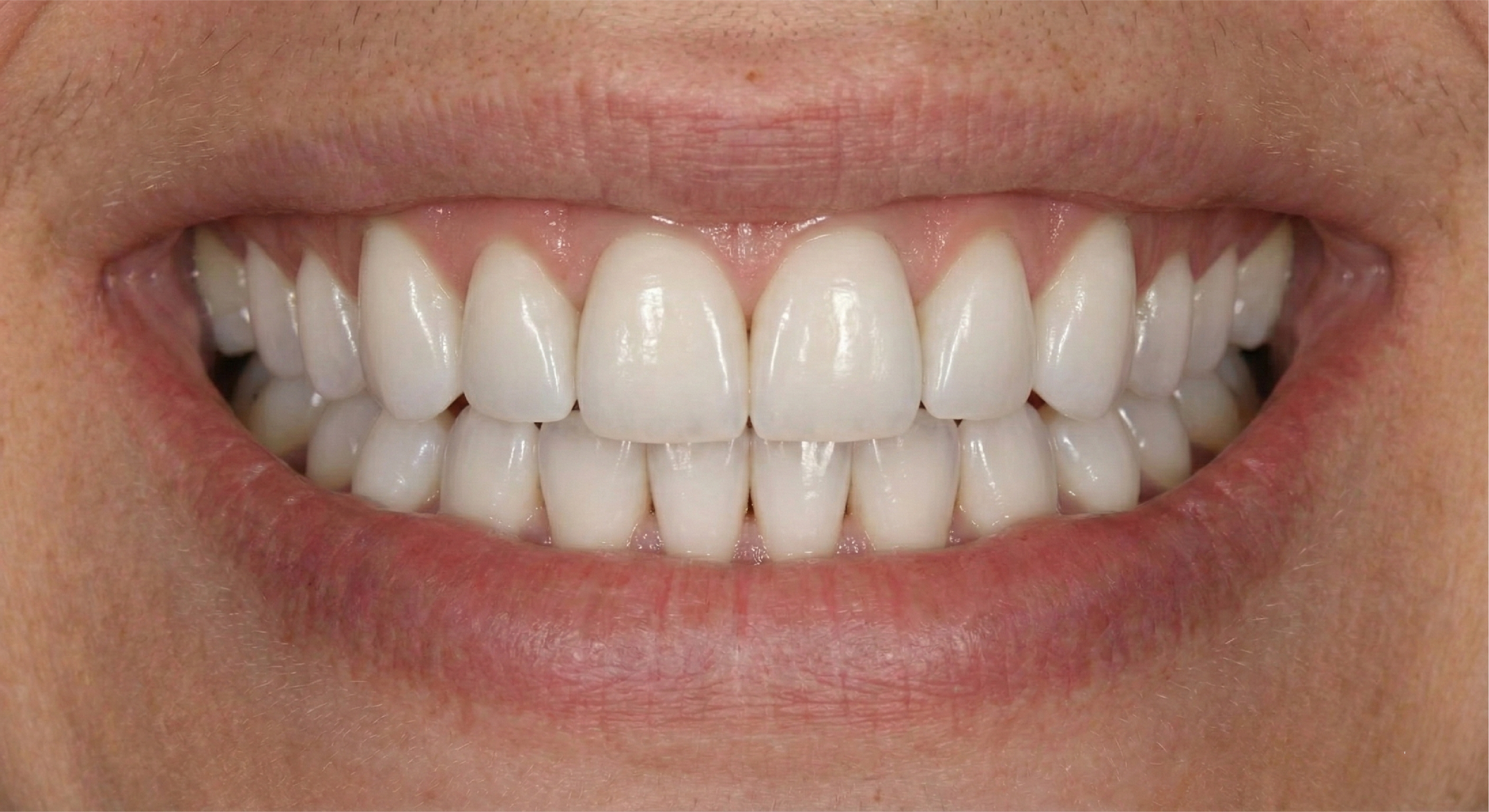 After — Porcelain Veneers